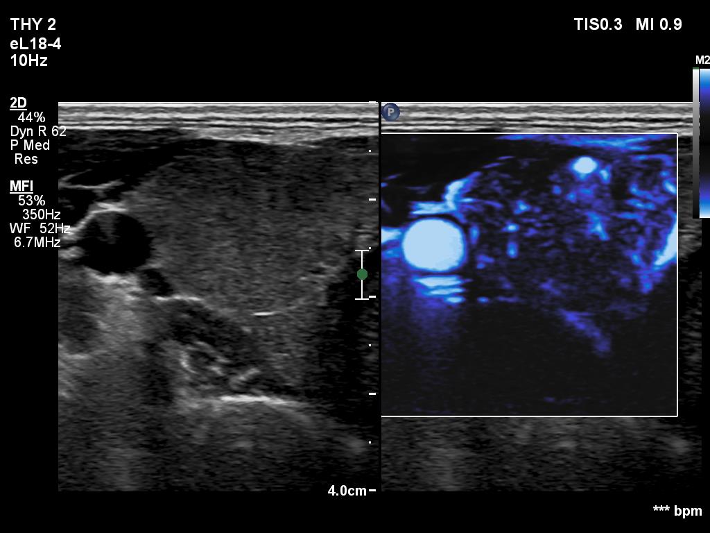 Right lobe, longitudinal scan