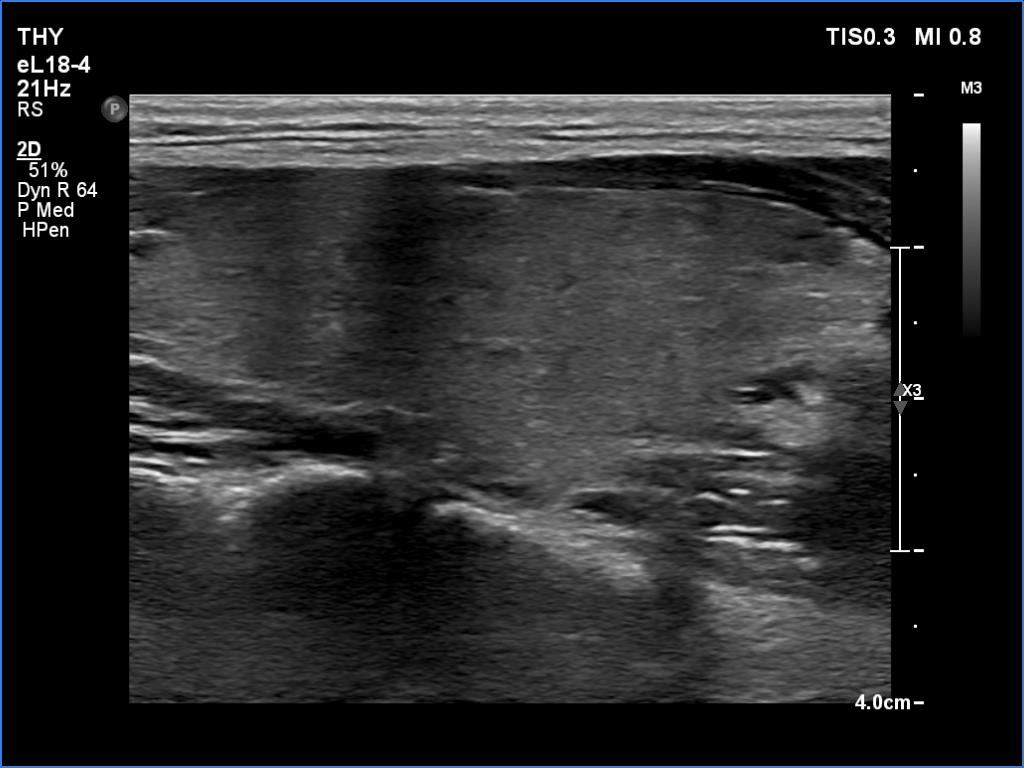 Right lobe, longitudinal scan