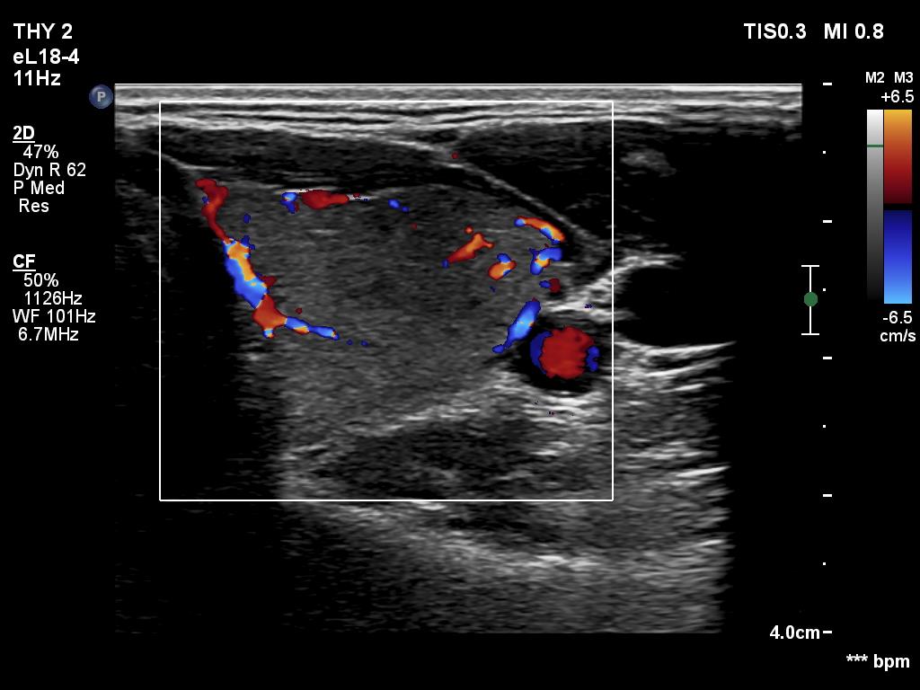 Right lobe, longitudinal scan