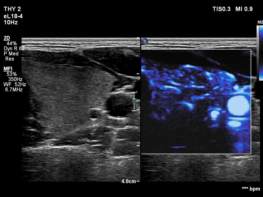 Right lobe, longitudinal scan