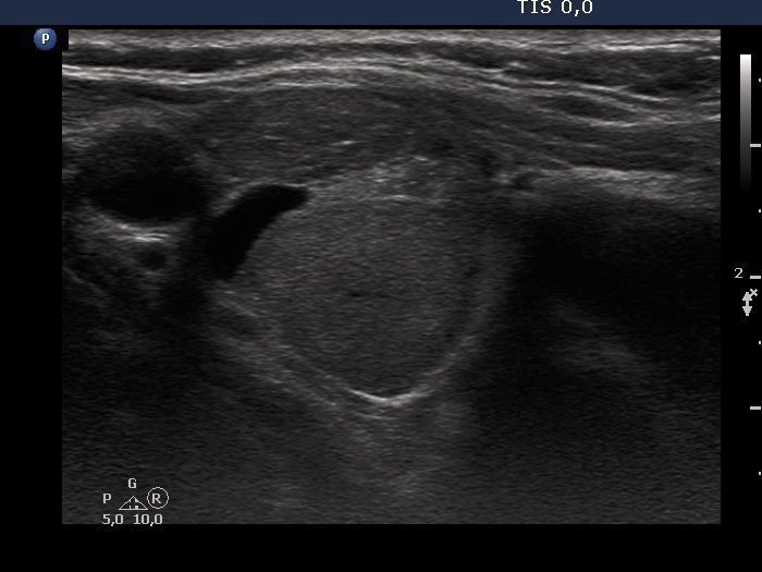 Right lobe, longitudinal scan