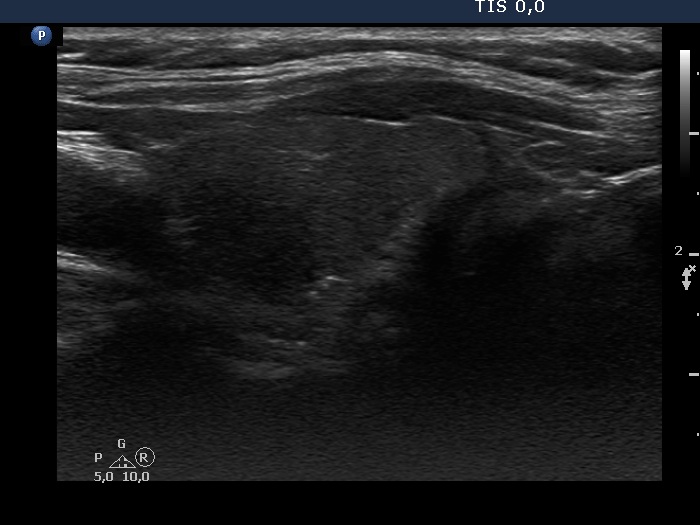 Right lobe, longitudinal scan