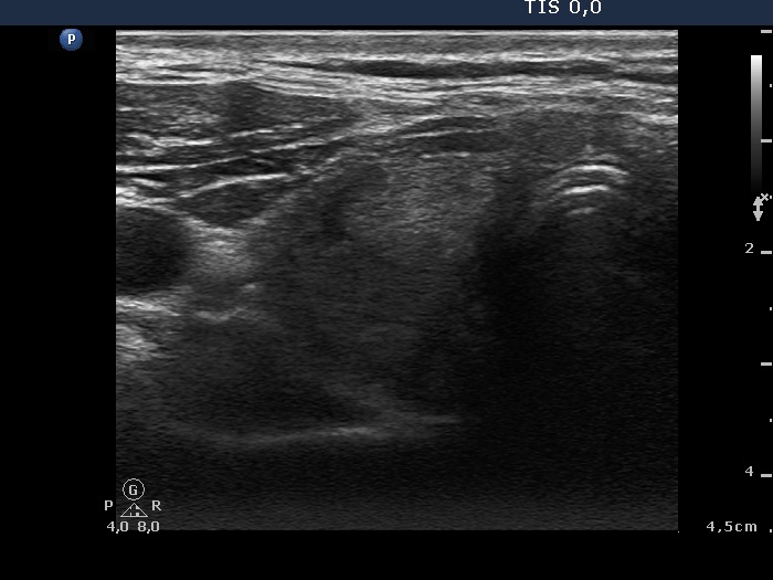 Right lobe, longitudinal scan
