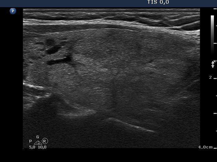 Right lobe, longitudinal scan