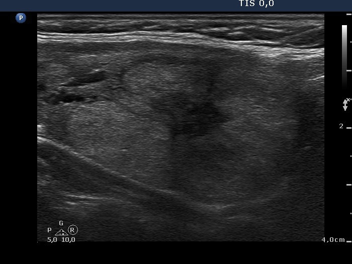 Right lobe, longitudinal scan