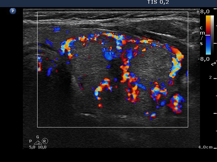 Right lobe, longitudinal scan