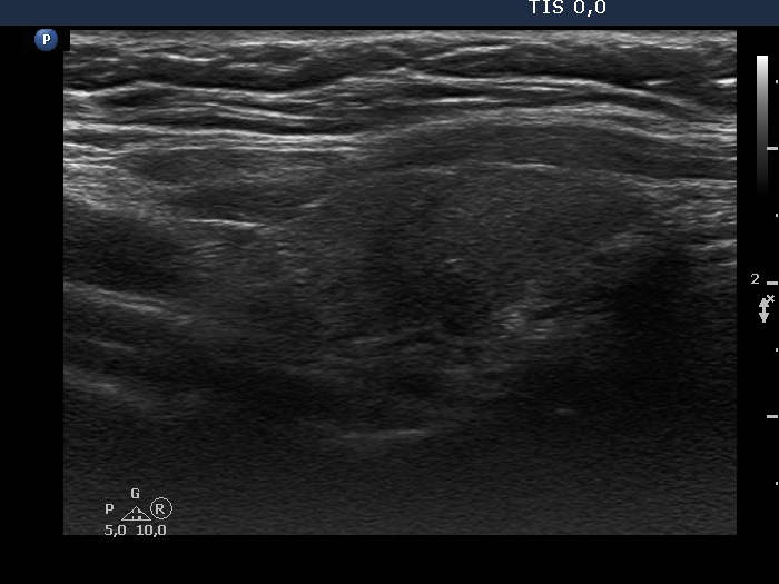 Right lobe, longitudinal scan