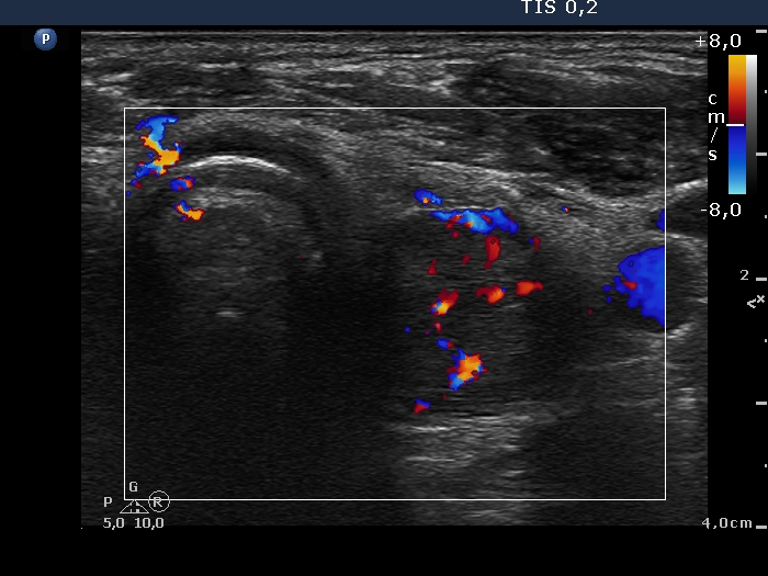 Right lobe, longitudinal scan