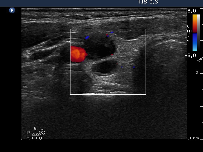 Right lobe, longitudinal scan
