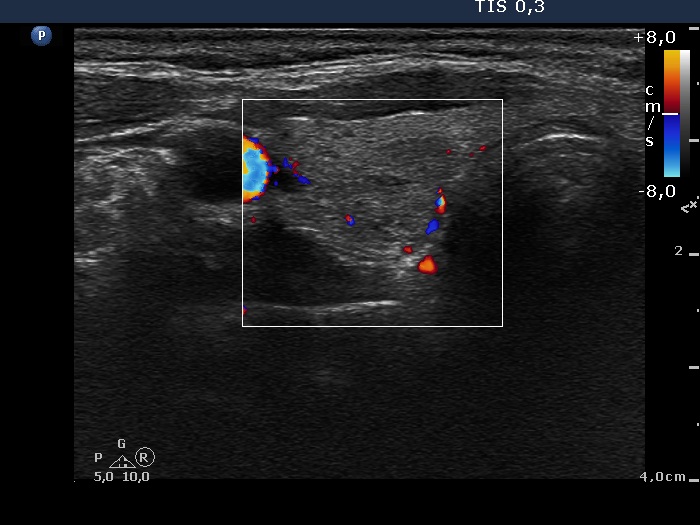 Right lobe, longitudinal scan
