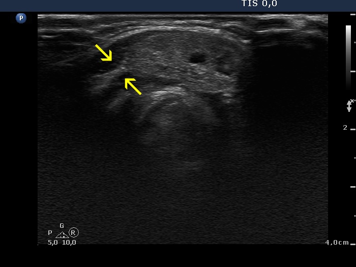 Right lobe, longitudinal scan