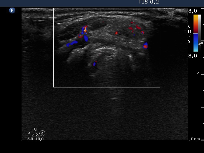 Right lobe, longitudinal scan