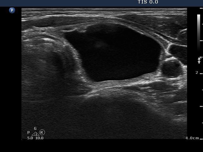 Right lobe, longitudinal scan