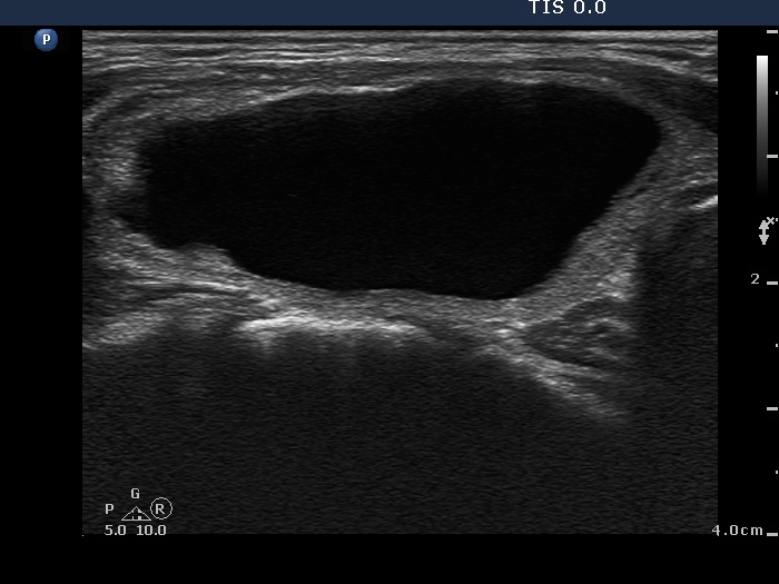 Right lobe, longitudinal scan
