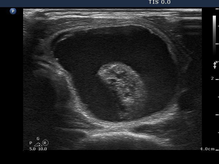 Right lobe, longitudinal scan