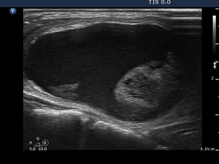 Right lobe, longitudinal scan
