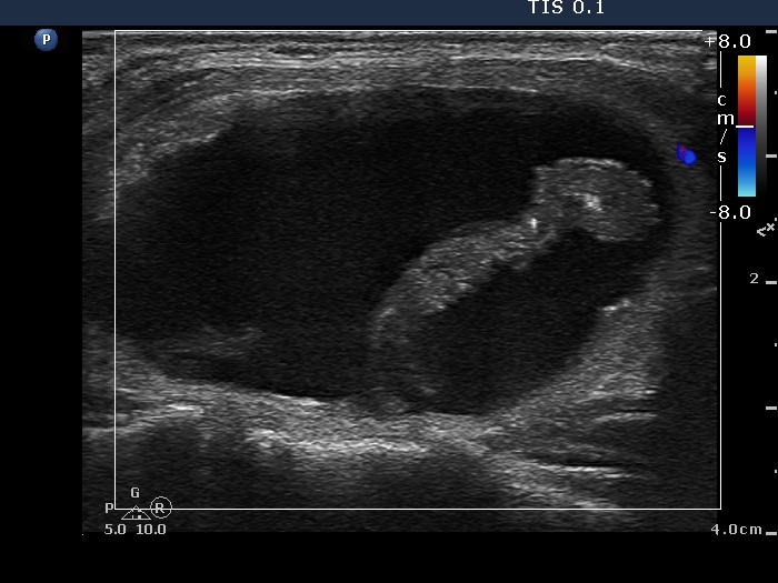 Right lobe, longitudinal scan