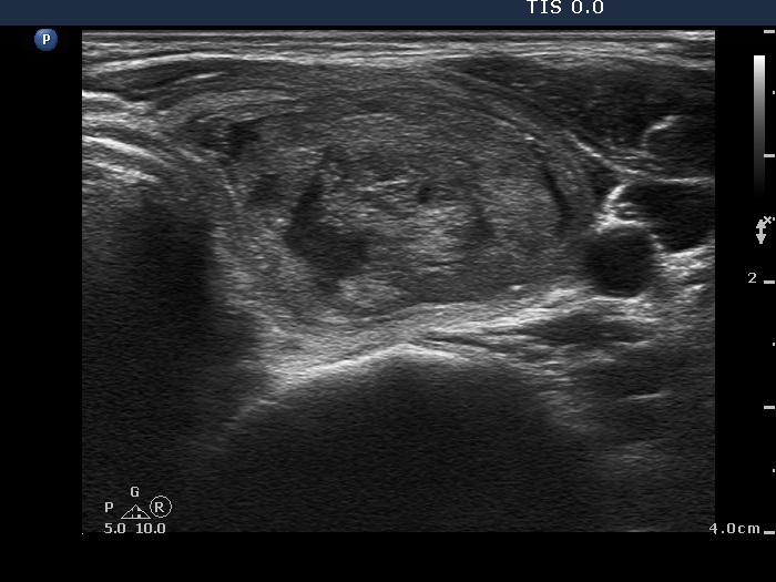 Right lobe, longitudinal scan