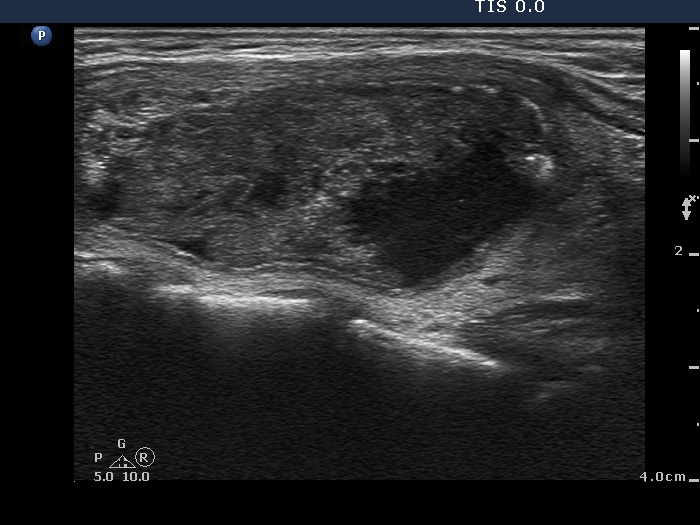 Right lobe, longitudinal scan