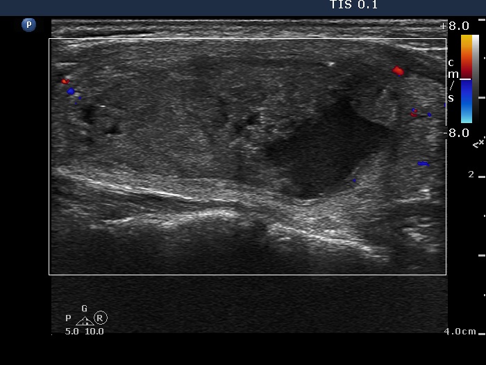 Right lobe, longitudinal scan