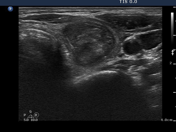 Right lobe, longitudinal scan