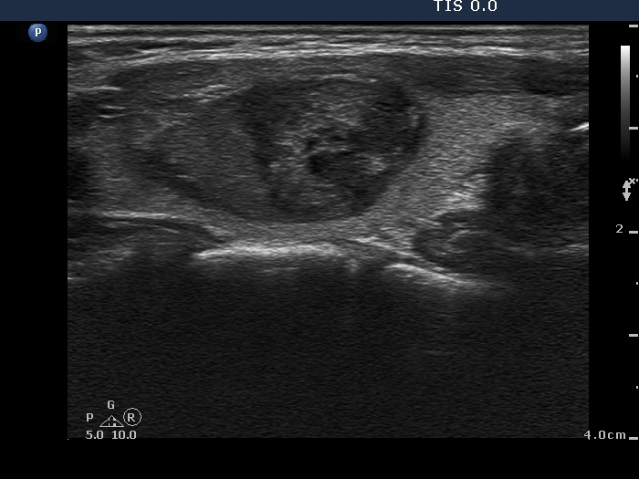 Right lobe, longitudinal scan