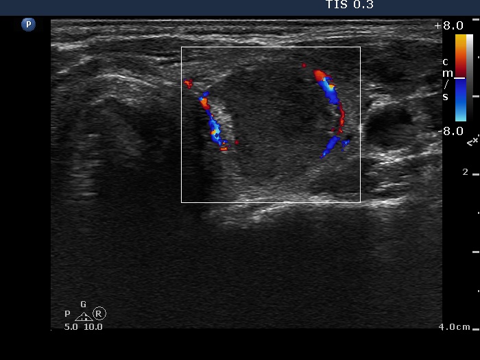 Right lobe, longitudinal scan