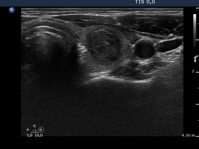 Right lobe, longitudinal scan