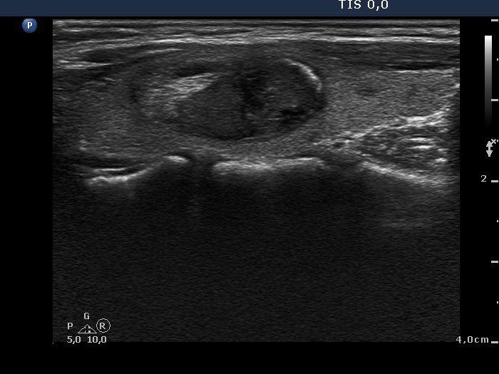 Right lobe, longitudinal scan
