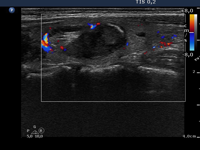 Right lobe, longitudinal scan