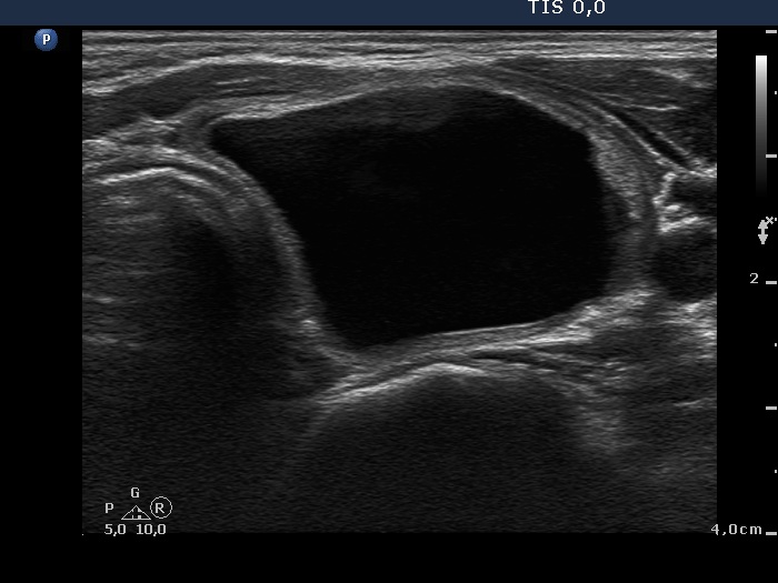 Right lobe, horizontal view