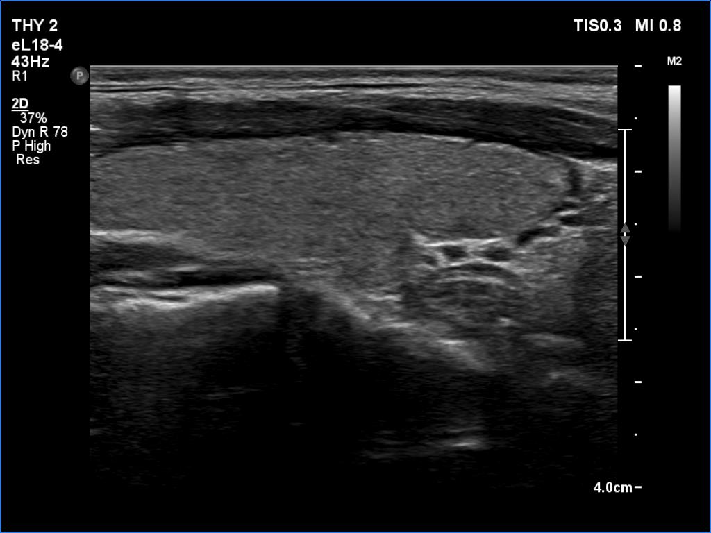 Right lobe, longitudinal scan