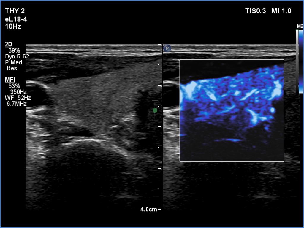 Right lobe, longitudinal scan