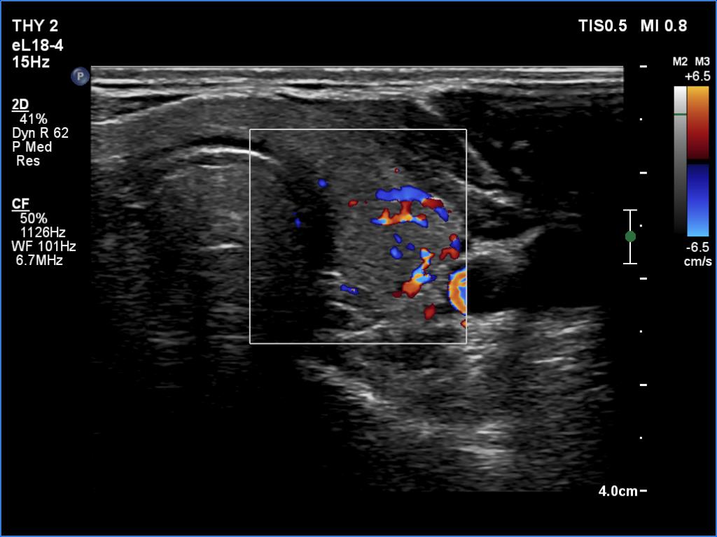 Right lobe, longitudinal scan