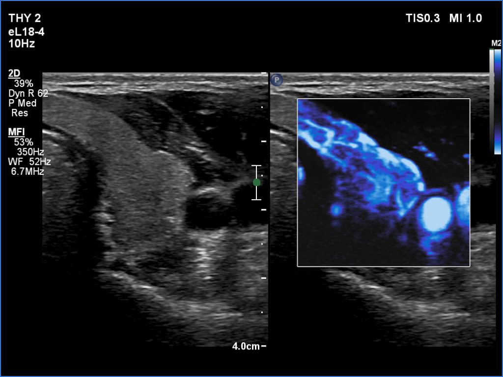 Right lobe, longitudinal scan