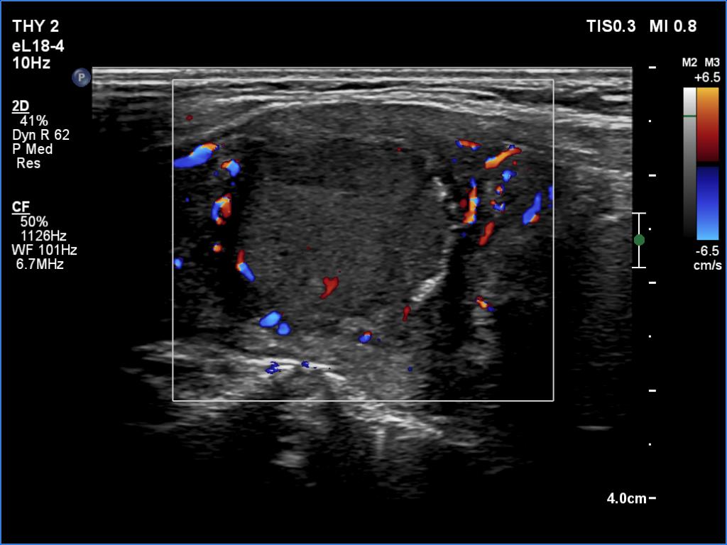 Right lobe, longitudinal scan