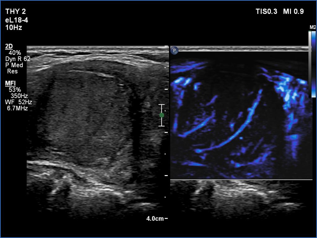 Right lobe, longitudinal scan