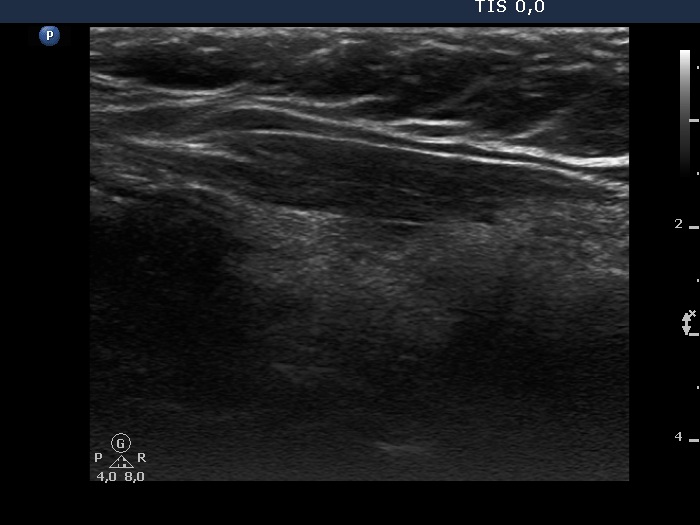Right lobe, longitudinal scan