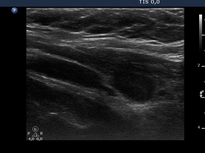 Right lobe, longitudinal scan