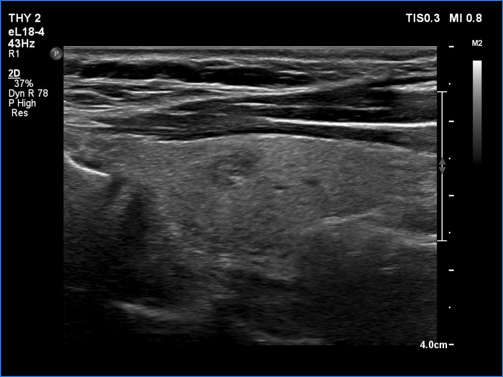 Right lobe, longitudinal scan