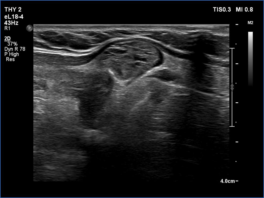 Right lobe, longitudinal scan
