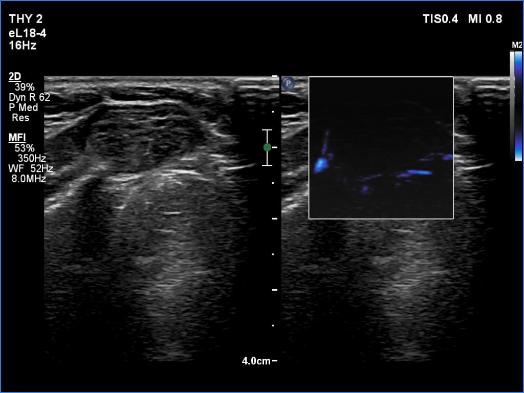 Right lobe, longitudinal scan