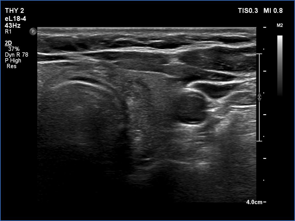 Right lobe, longitudinal scan
