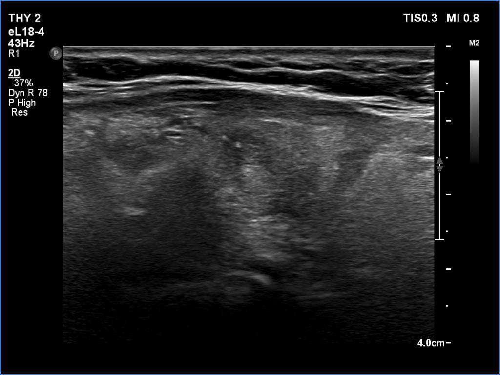 Right lobe, longitudinal scan