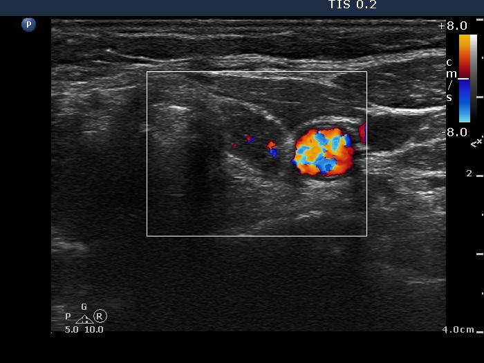 Right lobe, longitudinal scan