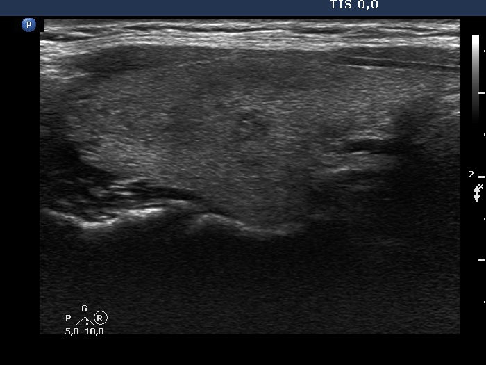 Right lobe, longitudinal scan
