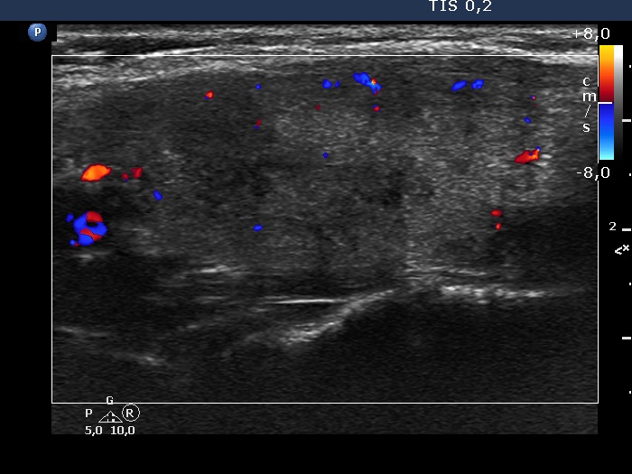 Right lobe, longitudinal scan