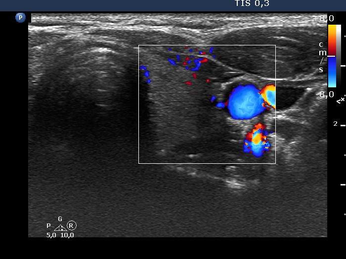 Right lobe, longitudinal scan