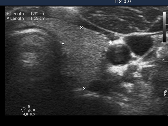 Right lobe, longitudinal scan