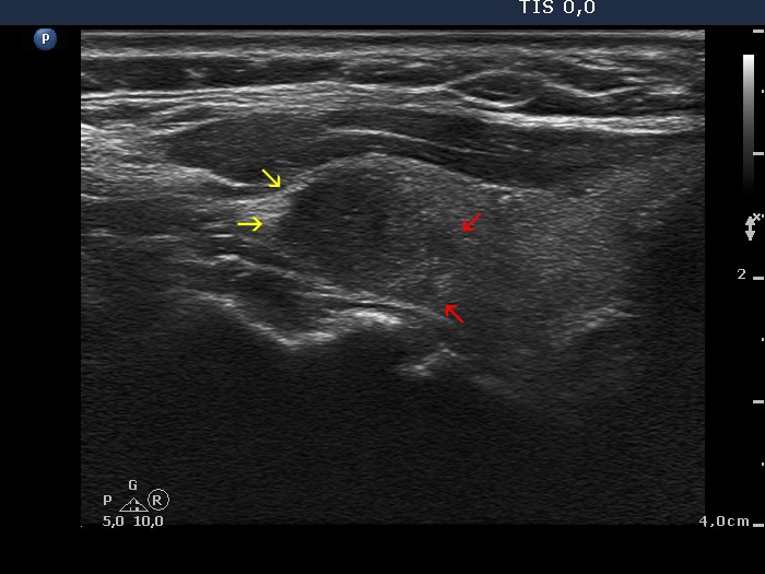 Right lobe, longitudinal scan